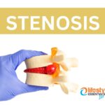 spinal stenosis